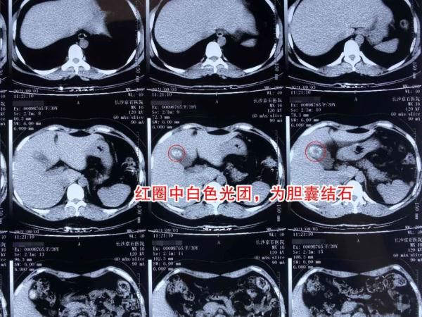 李小攀|女子胸口疼、全身发冷冒冷汗，就医才发现竟是胆囊结石所致