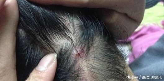 油脂|头皮上长出“小疙瘩”,可能是有大问题,为了家里人健康了解下!