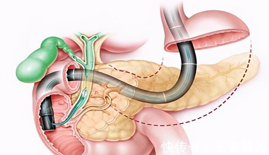 误诊|很会伪装的3大恶性肿瘤，往往发现便是晚期！出现这些症状莫大意