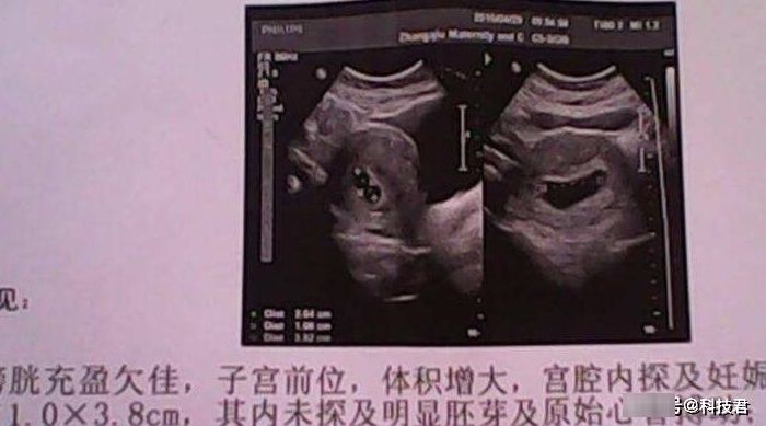 胎心率|产检时，孕妈若符合四种情况，可能怀的是一位“小王子”