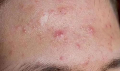 为什么“痘痘”在同一位置反复长？这个原因要知道