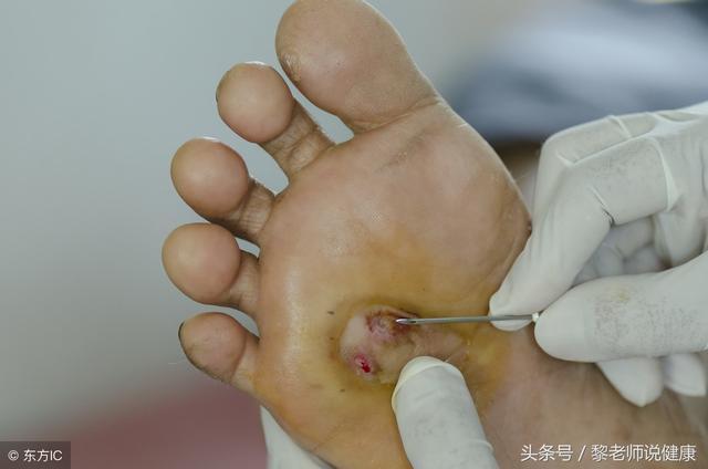 制品|糖尿病专家糖尿病患者用这些食疗方,可像正常人一样活到80岁