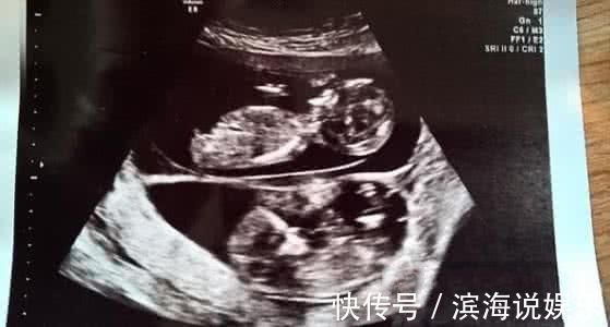 赫德森|女子怀孕五个月后再度怀孕,医生检查过后,丈夫顿感泣不成声