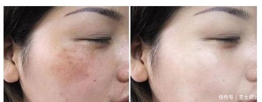 抗氧化剂|它是晒斑的''死对头'',每天坚持吃一点,挡住紫外线,肌肤年轻态