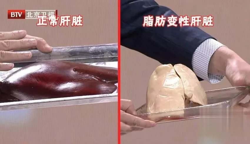 茶多酚|得了脂肪肝,全身都受累,4大癌症风险骤增,还伤血管!这份“逆转方法”请收好~