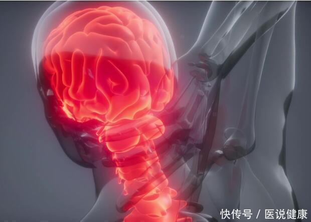 发育不良|身体出现四个异常信号，或与颈动脉狭窄有关，发现后，谨防脑梗