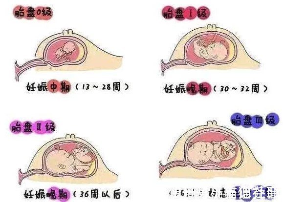 胎盘|孕晚期最后一个月，做产检时，要记得问医生4个问题！