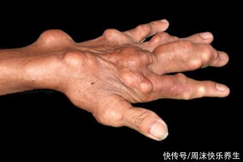 嘌呤含量|高嘌呤食物被揭晓,第一名不是海鲜也不是高汤,而是你常吃的美食