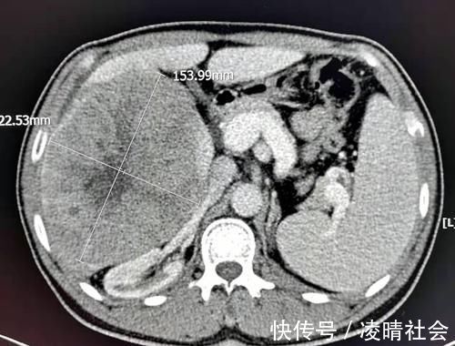 病人|对癌症病人隐瞒病情,是善意的谎言吗?对治疗有帮助吗?