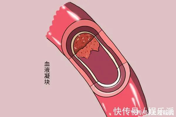淤青|没磕没碰，为何身上总有淤青？或许与这些原因有关系，别忽视