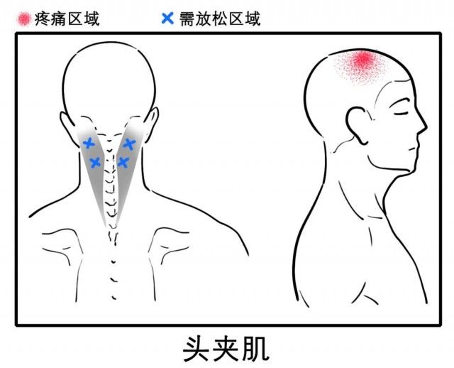 颈椎|八成头痛和颈椎有关！一份“疼痛位置图解”帮你对症放松