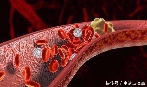 梨子|“溶栓高手”发现了,不是洋葱,隔三差五地喝,血栓也许悄悄没了