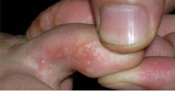 中醫|生姜、鹽水巧治腳氣，斬草除根！附老中醫治腳氣名方、驗方