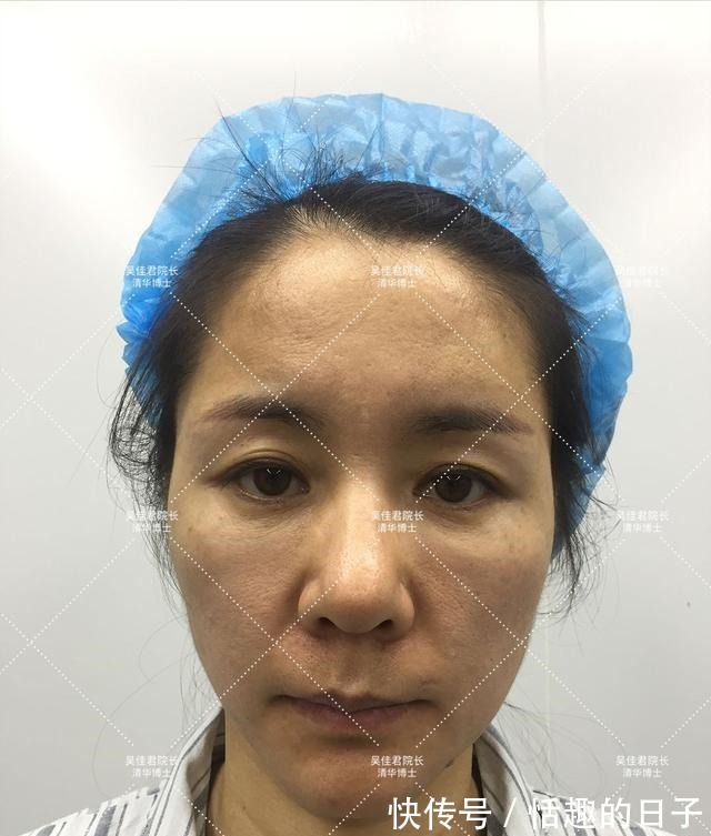 线雕 44岁小拉皮术后5个半月,用亲身经历谈一谈我的感受!