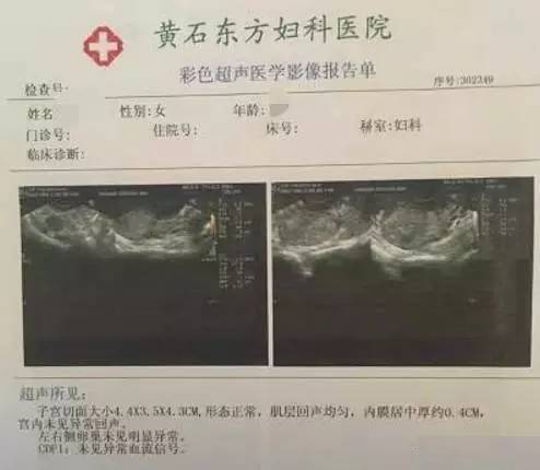 肌瘤|艾灸60天，子宫肌瘤完全消失！得了肌瘤，请至少给艾灸一次机会！