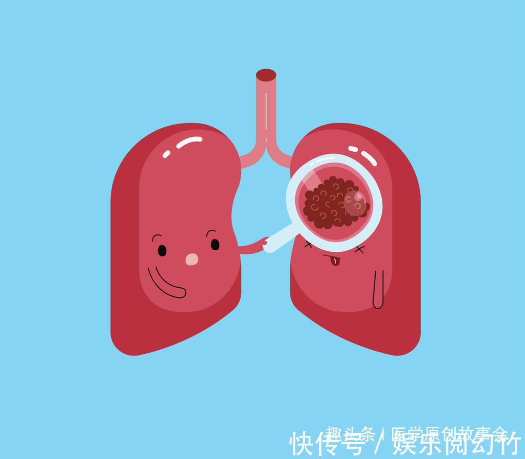 卫星灶|三种结节一旦发现,最好及时切除,一拖再拖会变成恶性肿瘤