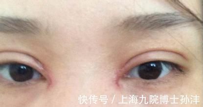 洁净 为什么你的双眼皮手术恢复的比别人慢?