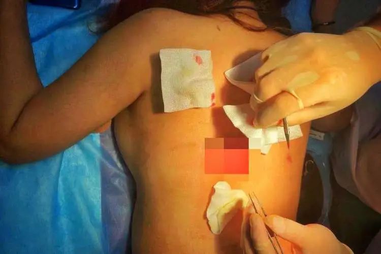 妙龄|妙龄女子吸脂手术，溃烂到无法缝合