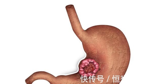 胃酸|慢性胃炎一定要多吃!慢性胃炎一定要多吃!