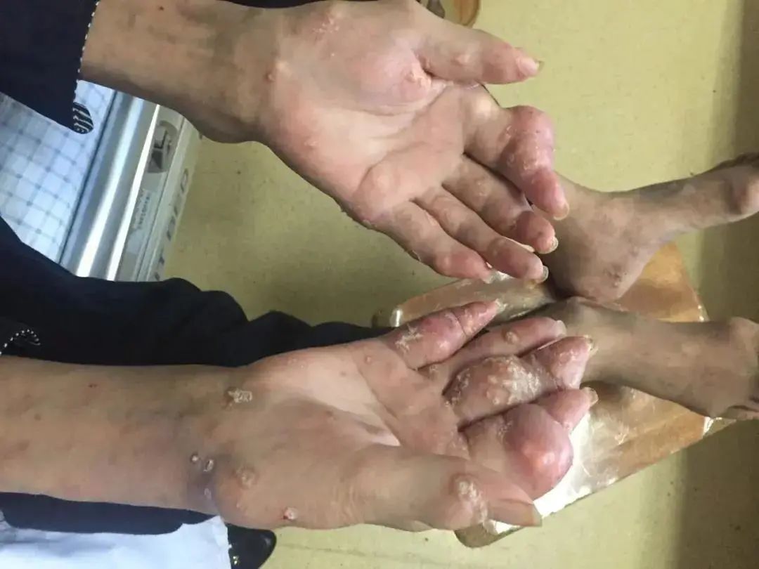 风湿免疫|男子手脚长满“石头”，不幸截瘫！有这些习惯的人要小心...