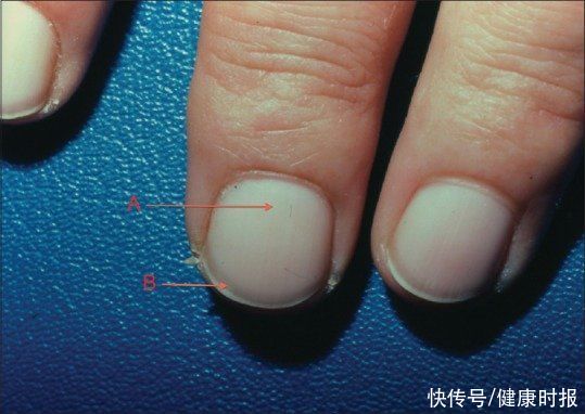 充血性|你的肾好不好,看指甲就知道!医生:指甲长成这样的要小心了