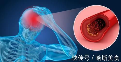 临床表现|腔隙性脑梗死就是脑梗死吗?药师提醒,这些危险因素要尽早控制