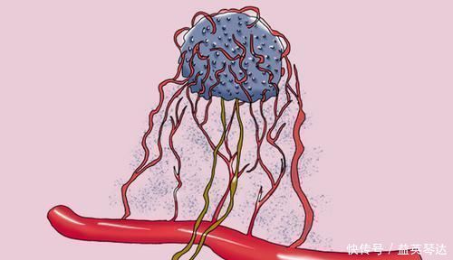 癌症复发|为何有的癌症患者一年就复发,有人却20年才复发?