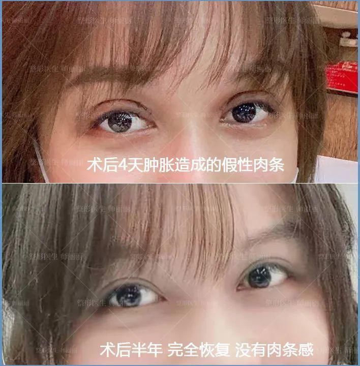 组织|双眼皮术后出现肉条的不同原因和修复方法