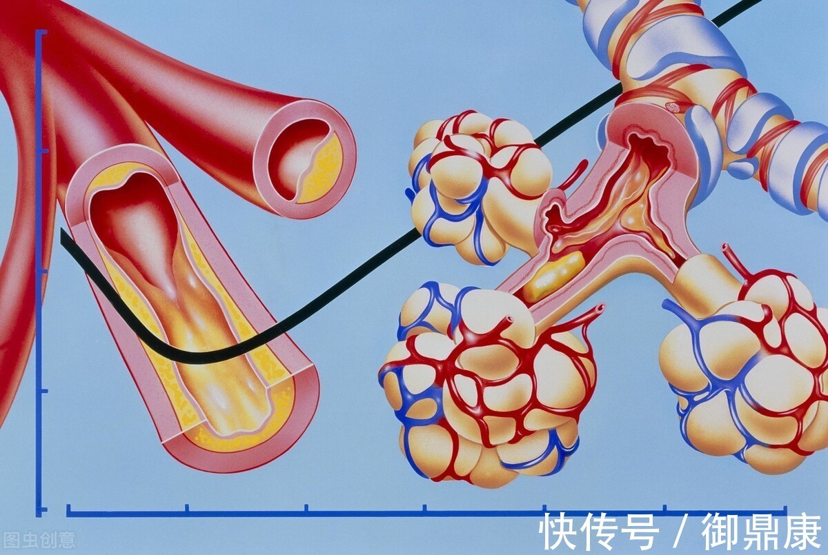 斑块|血脂2项、4项、7项有何区别？医生告诉你答案