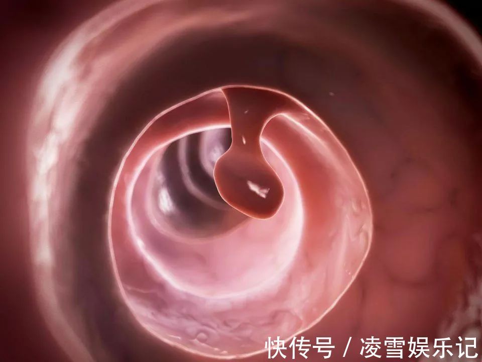 胃息肉|长大后,它就成了癌!到底要多久?看完这篇,了解息肉的全部