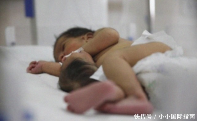 畸形|刚出生的双婴儿“第二个宝宝头颅”长在肚子上,心疼妈妈跟宝宝