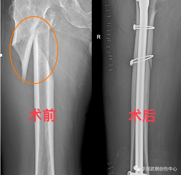 近百岁老人摸黑行走不慎摔断腿，医生1小时“巧手接骨”