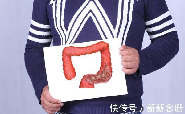 大便|肠癌早期也有症状可循的,四个排便异常,被不少人忽略了
