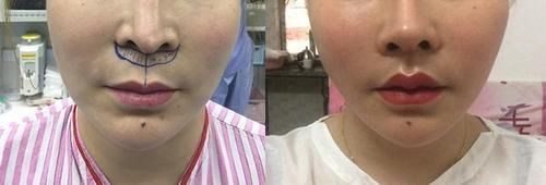 不到50岁就老成大妈？小拉皮术后6个月轻松实现逆生长！