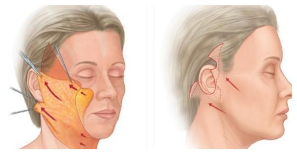 面部 51岁小拉皮术后1个月,我想跟大家说点真心话