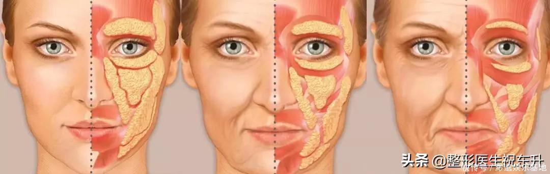 皮肤|奔着年轻去做的大拉皮,怎么脸还“垂”得更快了?