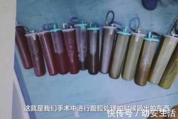 医生|男子饭后肚子发生爆炸,医生从其腹腔吸出3000毫升粪水
