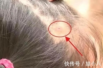 种病毒|爸爸帮女儿梳头,头皮上现白色“小球”,医生拔出后大开眼界