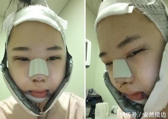 疼痛|小脸确实更可爱,看完整容过程,只觉得满屏的疼痛