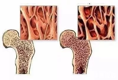 骨密度|每天搓一搓,95岁的他,骨密度远超60岁老人!赶紧学起来!