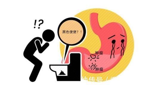 恶性肿瘤|直肠癌多半是拖出来的？4种异常迹象，暗示直肠已“亮红灯”