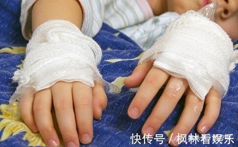 奇奇|男婴被100度开水烫伤后,妈妈做法遭全家反对,却得到医生点赞