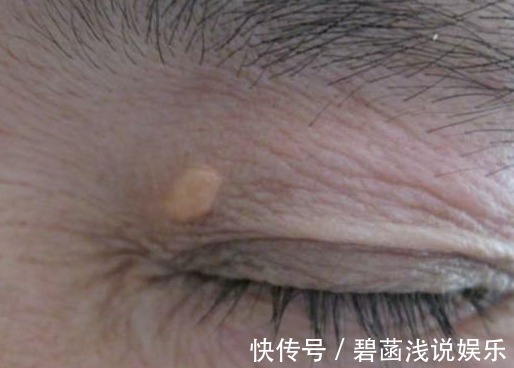 降血脂|血脂高不高,看脸上三个地方就知道,降血脂:四种食物一口别吃