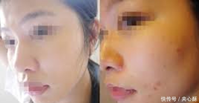 忽视|给乙肝患者提个醒,肝功能异常有3个信号,别忽视了