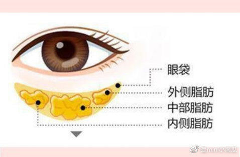 眼袋吸脂术要注意什么？眼袋吸脂术后护理怎么做？