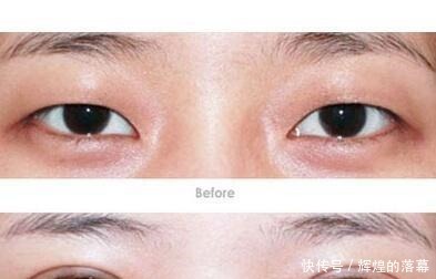 手术|做过双眼皮手术的年轻人,老了以后眼睛会怎么样看来是这个道理!