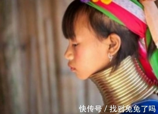 铁圈|女子套五公斤铁圈,五年来不堪其扰,结果怎么样了?