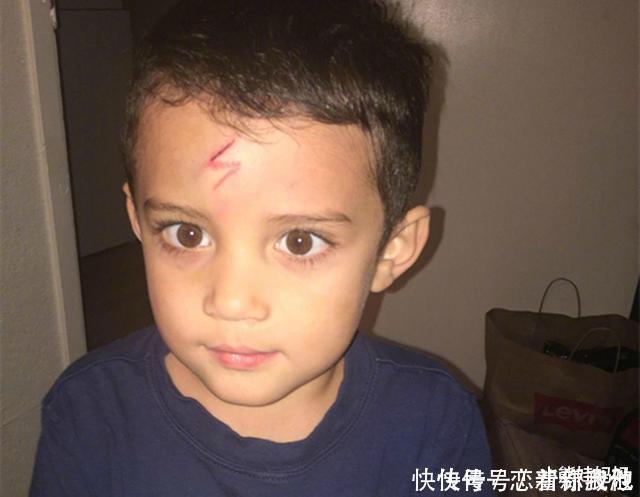 男孩不小心磕破了额头,宝妈灵机一动,让娃变成了“哈利波特”