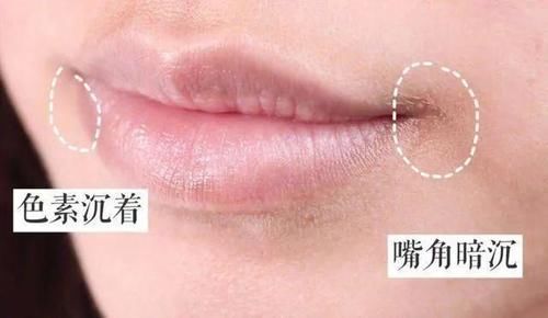怎么淡化唇及唇周黑色素沉淀？