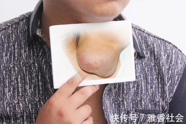 治愈|肿瘤扩散后，还需不需要治疗符合两种情况，被治愈是很有可能的